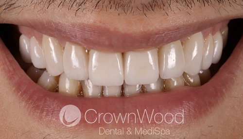 After 14 ceramic crowns fitted at CrownWood