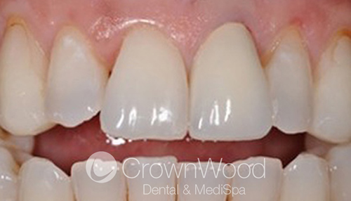 After dental crowns near me at CrownWood Dental