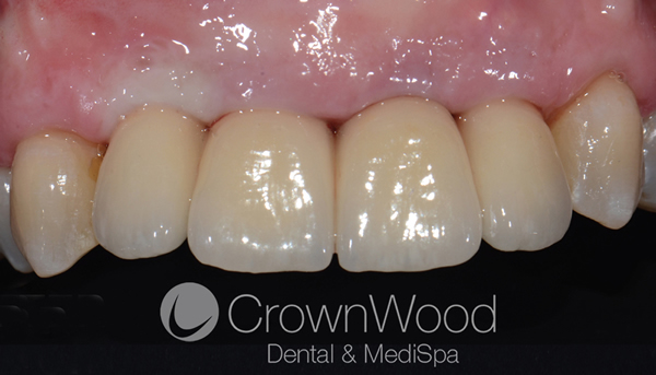 After bridge teeth implants near me at CrownWood Dental
