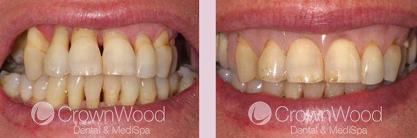 Gingival Veneer Before and After Treatment