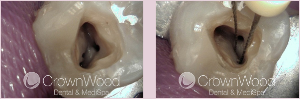Locating a Root Canal during Treatment