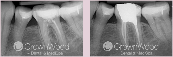 After specialist endodontist near me treats root canal (lower-Left 6)