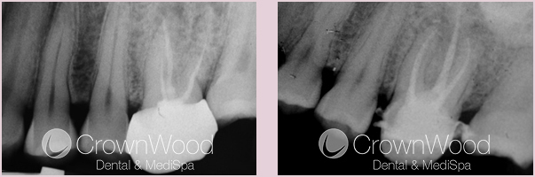 Successful root canal treatment for upper left molar by endodontist near me at CrownWood
