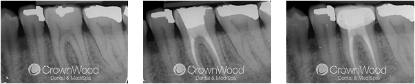 Root Canal Before and After Treatment