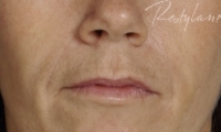 Nasial labial Folds - After Treatment