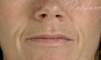 Nasial labial Folds - Before Treatment