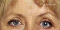 Glabella (between eyebrows) - After Treatment
