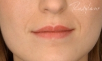 Lip Enhancement - Before Treatment