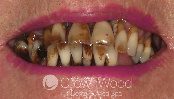 Before teeth in a day at CrownWood Bracknell