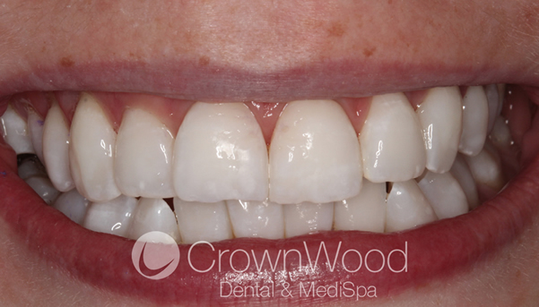 After Icon white spot treatment
