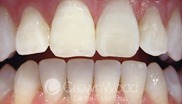 After Icon teeth treatment