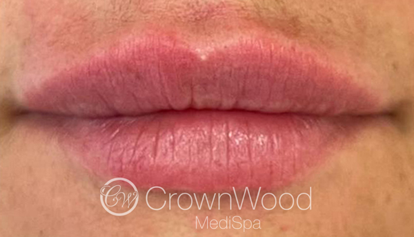 After lip fillers in Bracknell by Dr Victoria Jaminson