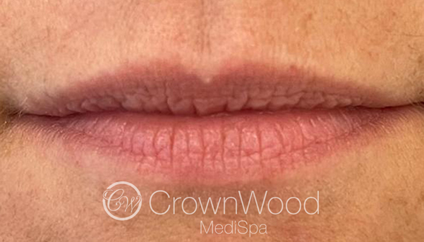Lip Fillers - Before by Dr Victoria Jaminson