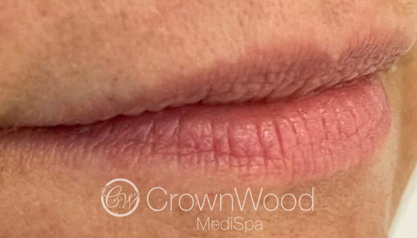 Lip Fillers before by Dr Victoria Jaminson