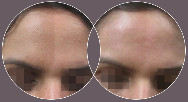 ClearLift laser face treatments Berkshire