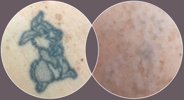Laser tattoo removal near me