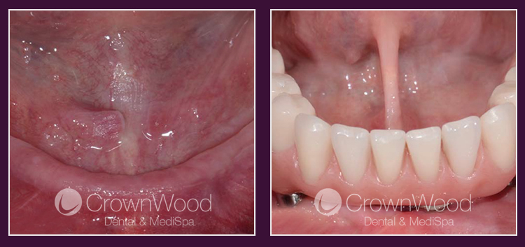 All-on-4/6 Dental Implants at CrownWood MediSpa Bracknell