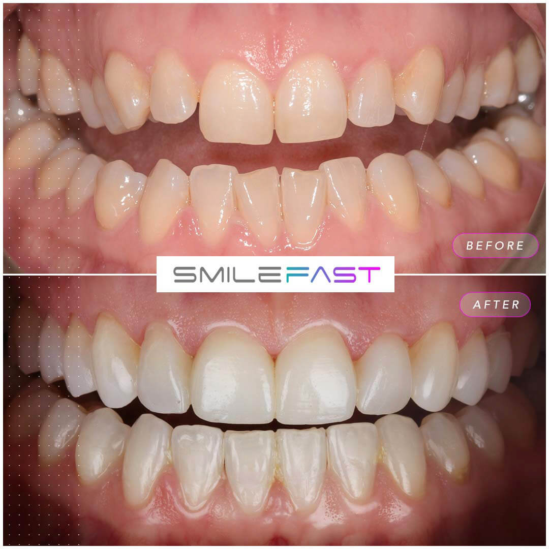 Before and after Smilefast