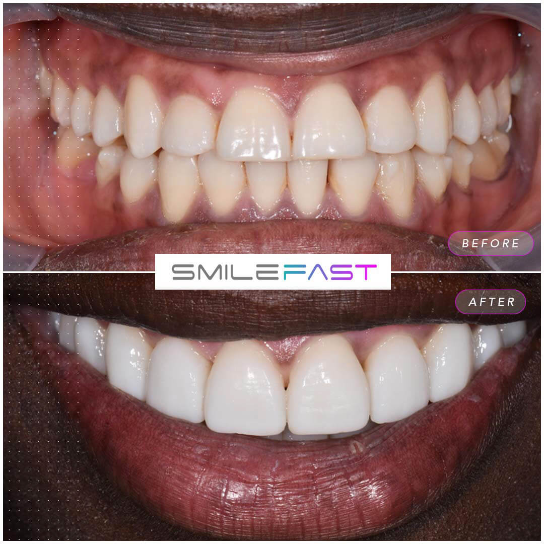 Before and after Smilefast Bracknell