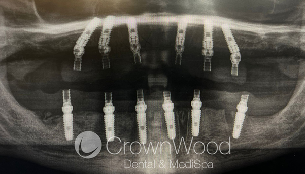 X-ray of all on 6 Implants at CrownWood Bracknell