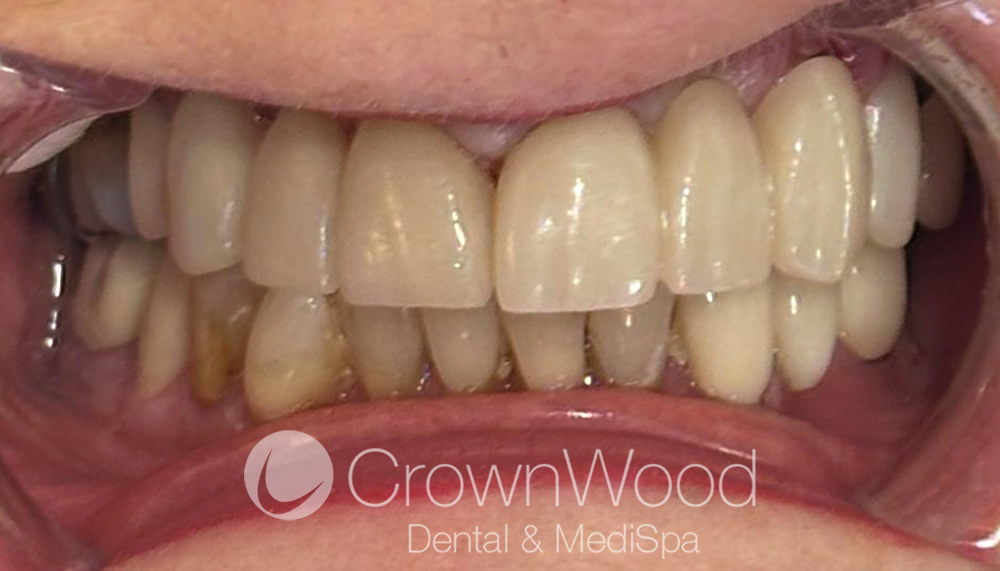 After Emax Porcelain Dental Bridge