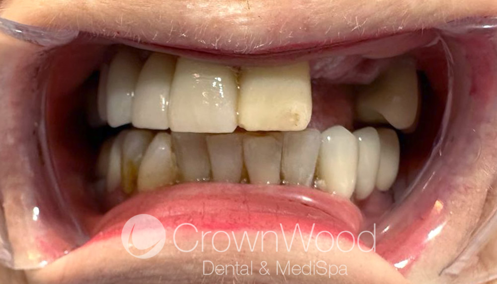 Before Emax Porcelain Dental Bridge