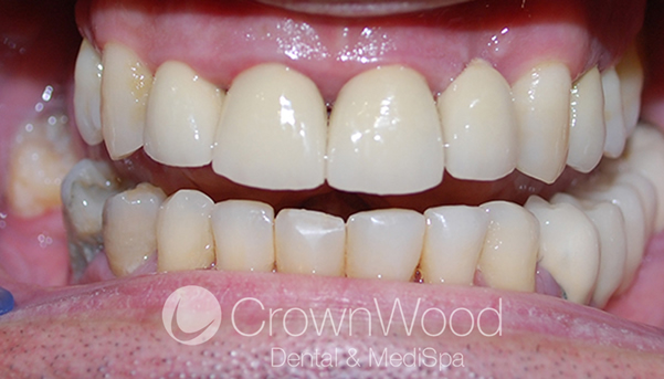 after dental bridges near me at CrownWood Dental