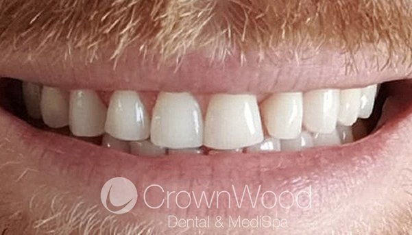 After Composite Bonding & Whitening at CrownWood Bracknell