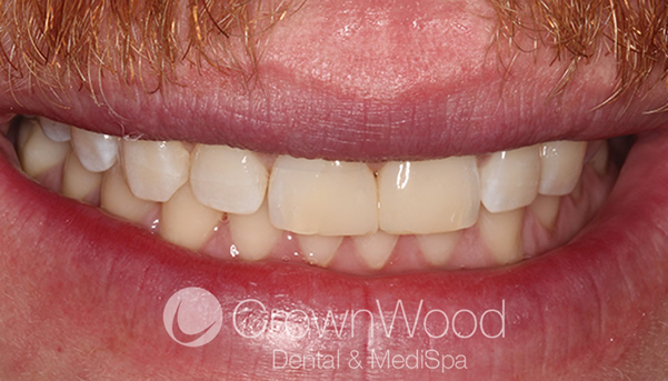 After Composite Diastema Closure in Berkshire