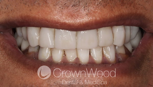 AfterComposite Veneers at CrownWood Bracknell