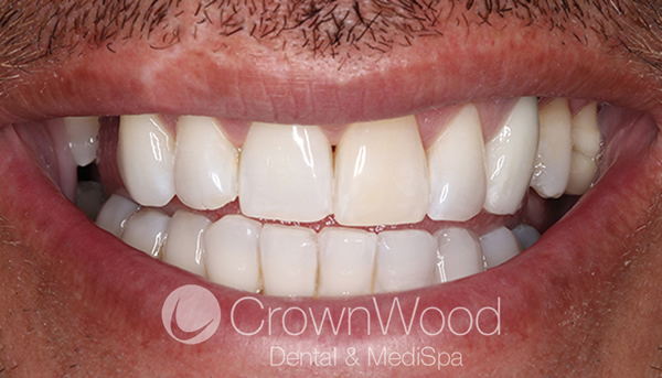 After cheap composite bonding near me at CrownWood Dental