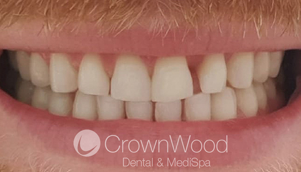 Before Composite Bonding & Whitening at CrownWood Bracknell