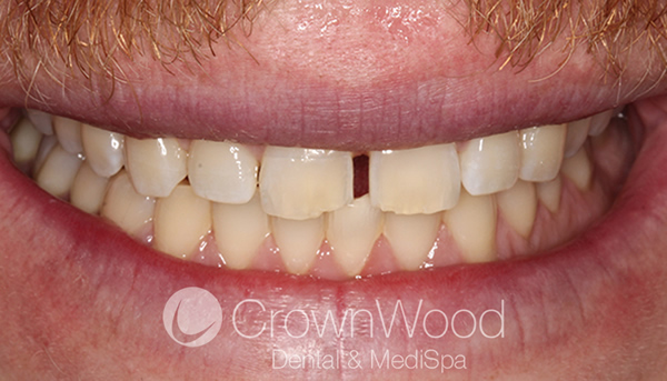 Before Composite Diastema Closure in Berkshire