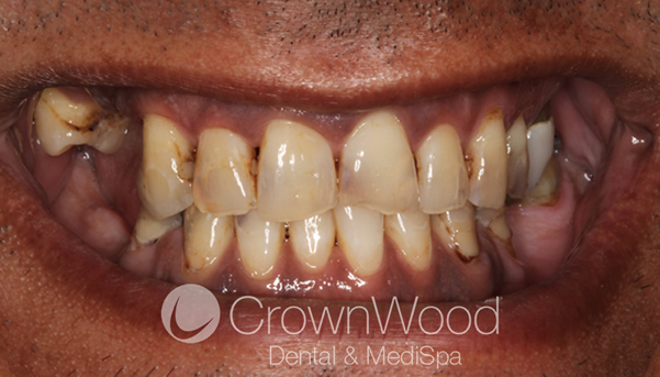 Before Composite Veneers at CrownWood Bracknell