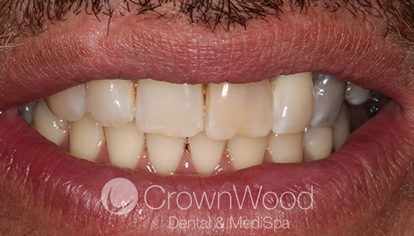 Before Composite Bonding at CrownWood Dental