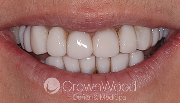 After Composite Veneers