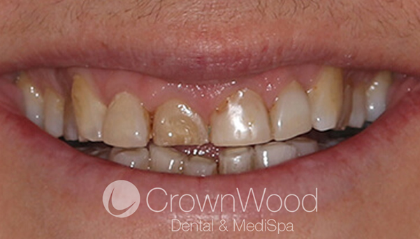 Before Composite Veneers