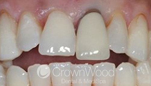 Dental Crowns Before