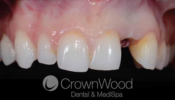 Before Individual Implant at CrownWood Dental