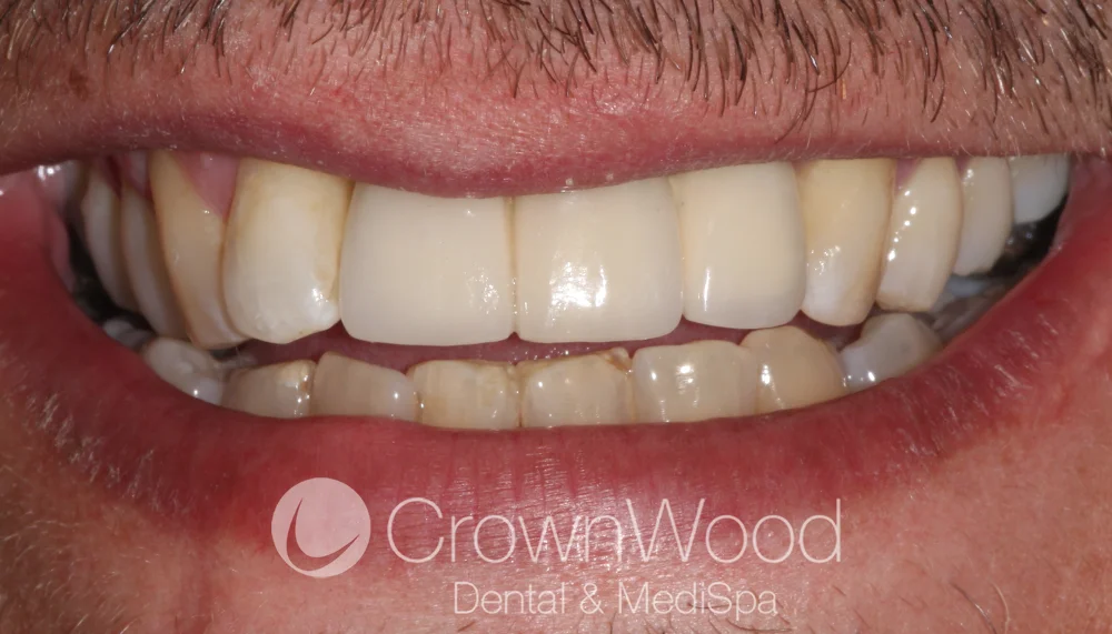 After implant bridge treatment