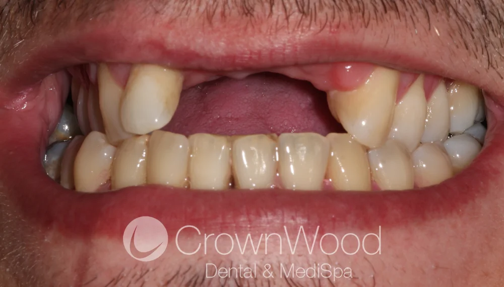 Before implant bridge treatment