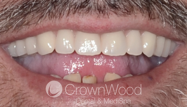 After Teeth implants near me at CrownWood Dental