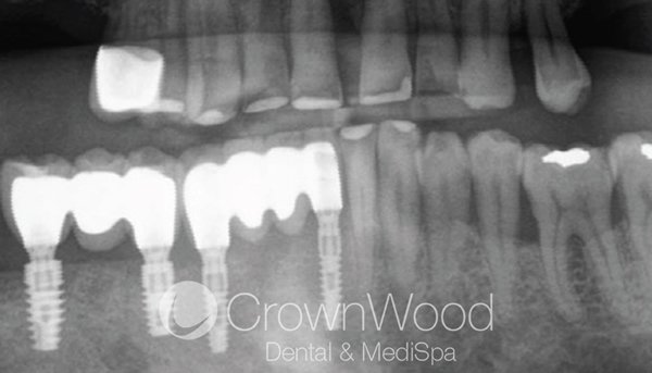 Xray after Implant bridge in Bracknell