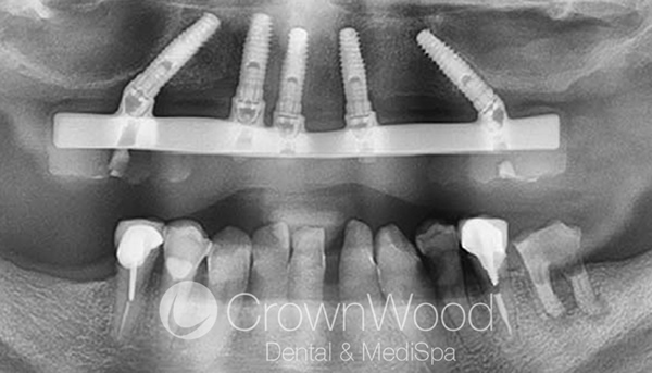 Xray After teeth in a day in Bracknell