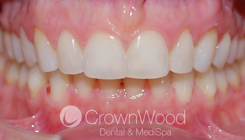 After Invisalign and Teeth Contouring at CrownWood Dental