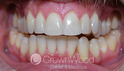 After Invisalign and Teeth Whitening at CrownWood Dental