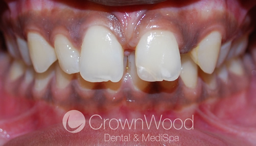 Cerys before Invisalign treatment by Chi at CrownWood Dental
