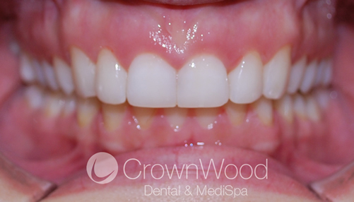 After Invisalign braces near me at CrownWood Dental