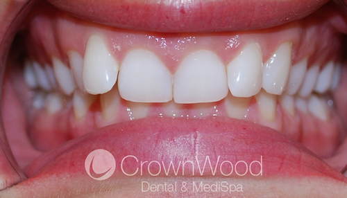 Greta before Invisalign and Contouring treatment by Chi at CrownWood Dental