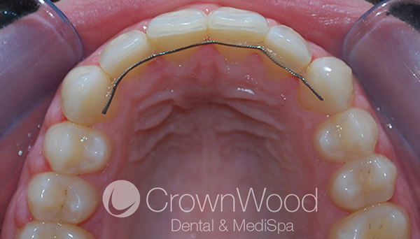 Invisalign crowding before and after